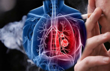 Akciğer kanserinin 5 önemli belirtisi 