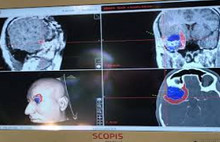 Alzheimer, neden en az Japonlar'da görülüyor