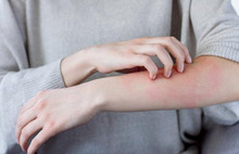 İstanbul'da uyuz endişesi...