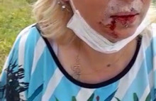 Hayvansever Kadına Şiddet: Çenesi Kırıldı