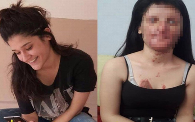 CHP’li Tanal, erkek arkadaşının asitle yüzünü yaktığı Berfin için harekete geçti